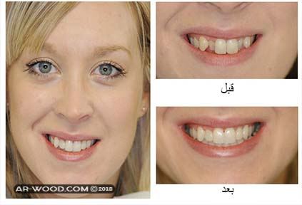 بروز الاسنان قبل وبعد 1