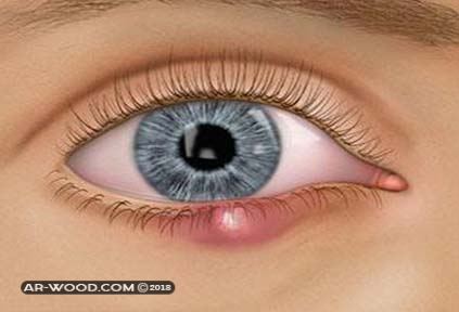 اسباب ظهور حبوب داخل جفن العين