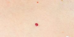 ظهور نقط حمراء صغيرة على الثدي